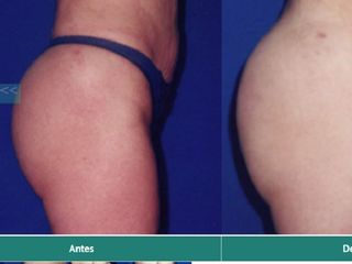 Aumento de gluteos