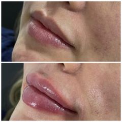 Aumento de labios - Dra. Carolin Diaz