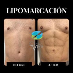 Liposucción - Clínica Vivir