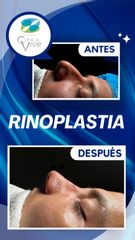 Rinoplastia - Clínica Vivir
