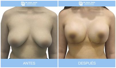 Levantamiento de senos - Dr. Raúl Daza