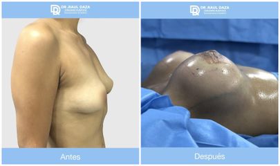 Mamoplastia de aumento - Dr. Raúl Daza