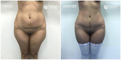 Abdominoplastia - Dr. Raúl Daza