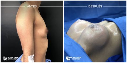 Mamoplastia de aumento - Dr. Raúl Daza