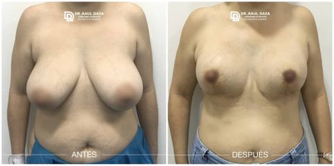 Mamoplastia de reducción - Dr. Raúl Daza