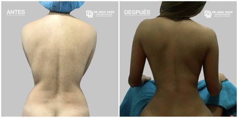 Liposucción - Dr. Raúl Daza