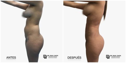Liposucción - Dr. Raúl Daza