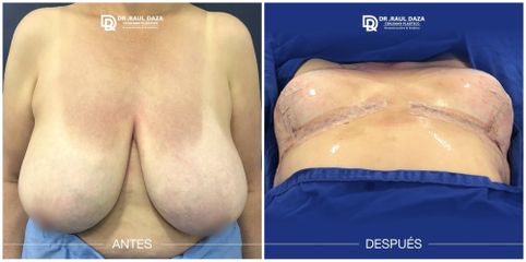 Mamoplastia de reducción - Dr. Raúl Daza