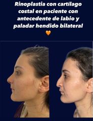 Rinoplastia - Dra. Erika Gutiérrez