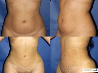 Lipoescultura, Antes y Después