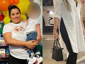 Balón Gástrico antes y después - 848395