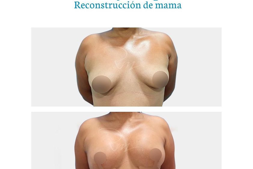 Reconstrucción mamaria antes y después - 776246
