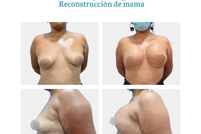 Reconstrucción mamaria antes y después - 776247