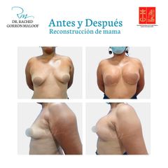 Reconstrucción mamaria - Dr. Rachid Gorron Maloof