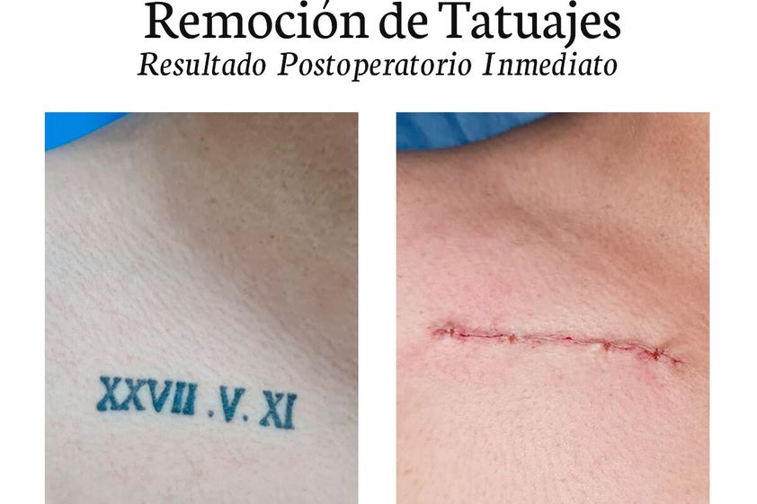 Borrar tatuajes antes y después - 776300
