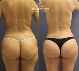Lipoescultura - Dra. Lina Rodríguez