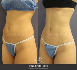 Liposucción - Dra. Lina Rodríguez