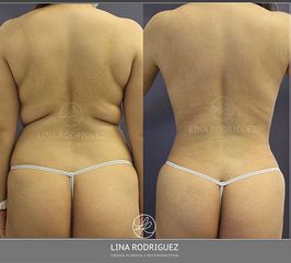 Lipoescultura - Dra. Lina Rodríguez