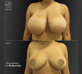 Mamoplastia de reducción - Dra. Lina Rodríguez