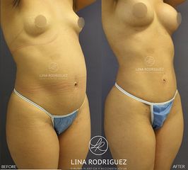 Liposucción - Dra. Lina Rodríguez