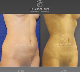 Liposucción - Dra. Lina Rodríguez