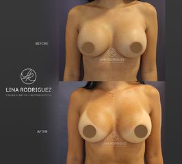 Mamoplastia de aumento - Dra. Lina Rodríguez