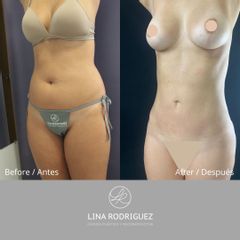 Liposucción - Dra. Lina Rodríguez