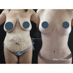 Mommy makeover - Dra. Lina Rodríguez