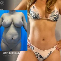 Lipoabdominoplastia + Mamopexia con implantes - Dra. Lina Rodríguez