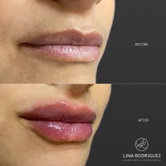 Relleno de labios con ácido hialurónico - Dra. Lina Rodríguez