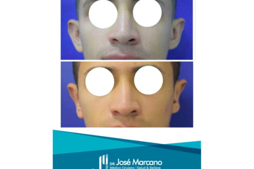 Otoplastia antes y después - 627205