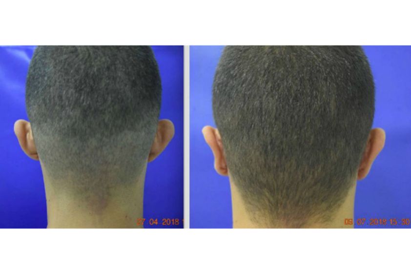 Otoplastia antes y después - 627206