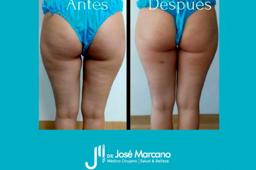 Celulitis antes y después - 627472