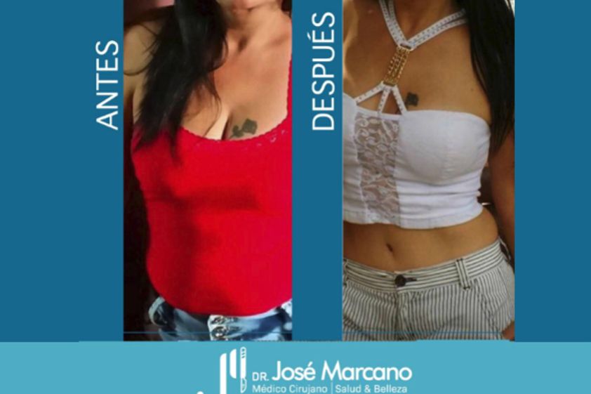 Tratamientos para adelgazar antes y después - 628048