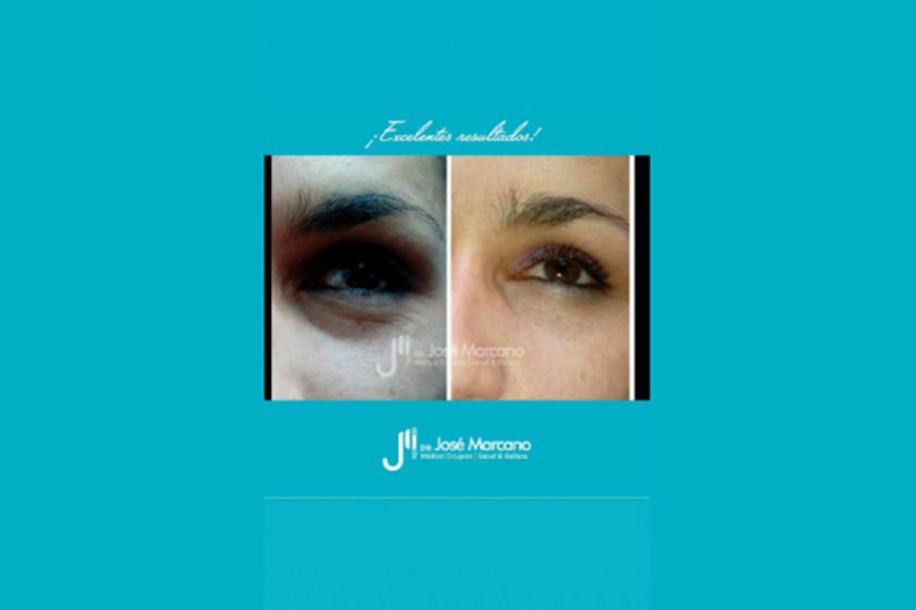 Eliminar ojeras antes y después - 629149
