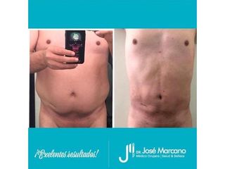 Abdominoplastia - Dr. Jose Alejandro Marcano Delgado