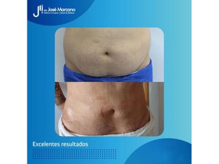 Abdominoplastia - Dr. Jose Alejandro Marcano Delgado