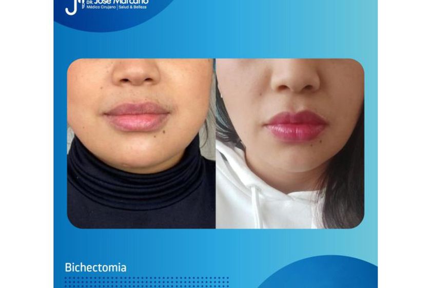 Bichectomía antes y después - 694191
