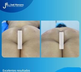 Aumento Gluteos  - Dr. José Marcano