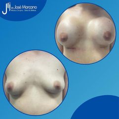 Mamoplastia de aumento - Dr. Jose Alejandro Marcano Delgado