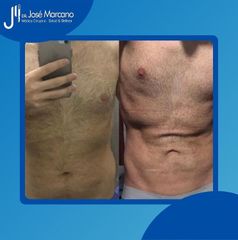 Abdominoplastia - Dr. Jose Alejandro Marcano Delgado