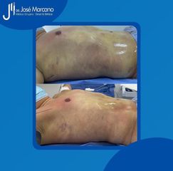 Liposucción - Dr. Jose Alejandro Marcano Delgado