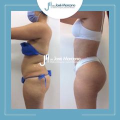 Liposucción - Dr. Jose Alejandro Marcano Delgado