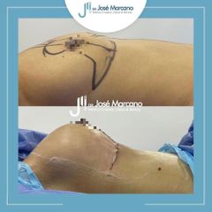 Mamoplastia de aumento - Dr. Jose Alejandro Marcano Delgado