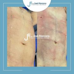 Marcación Abdominal - Dr. Jose Alejandro Marcano Delgado