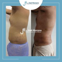 Liposucción - Dr. Jose Alejandro Marcano Delgado