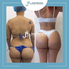 Liposucción - Dr. Jose Alejandro Marcano Delgado