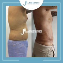 Liposucción - Dr. Jose Alejandro Marcano Delgado