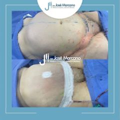 Abdominoplastia - Dr. Jose Alejandro Marcano Delgado