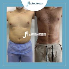 Liposucción - Dr. Jose Alejandro Marcano Delgado